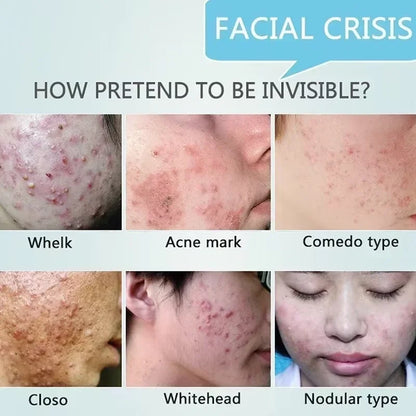 Pore Shrinking Cream Acne Pit Repair Products for Men and Women Remove acne mark scars Large pore anti-inflammatory smooth skin