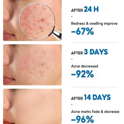 Salicylic Acid Acne Removal Cream Anti-Acne Repair Redness Pimple Spots Deep Cleaning Pore Oil Control Moisturizing Skin Care