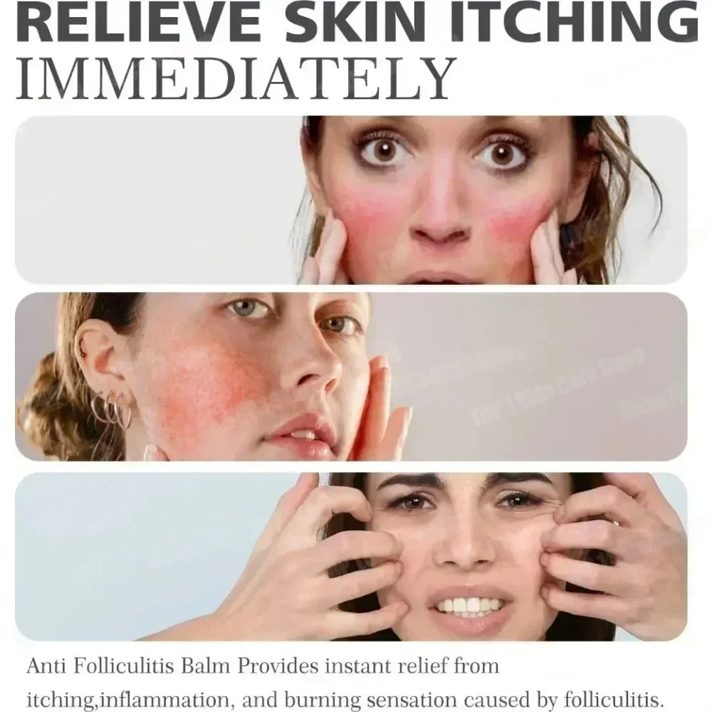 Anti-Acne Cream Effectively Removes Skin Nodules Pustules Cysts Papules Blackheads Men And Women Acne Skin Care Essence Cream