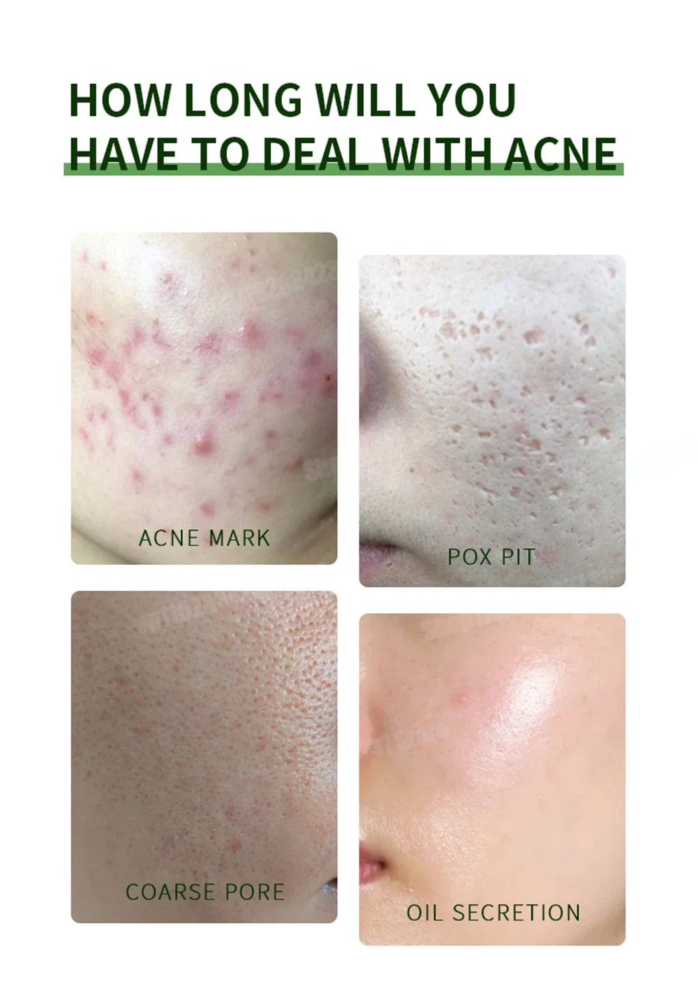 Anti-Acne Cream Effectively Removes Skin Nodules Pustules Cysts Papules Blackheads Men And Women Acne Skin Care Essence Cream