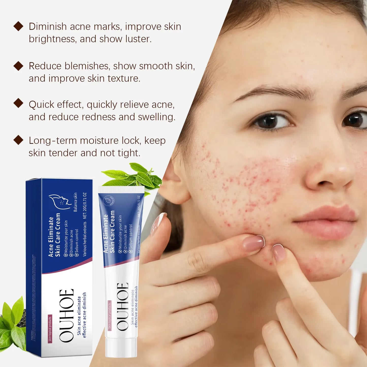 Pimple Acne Treatment Face Cream Oil Control Nourish Balance Refreshing Repairing Pimple Remover Acne Removing Cleansing Cream