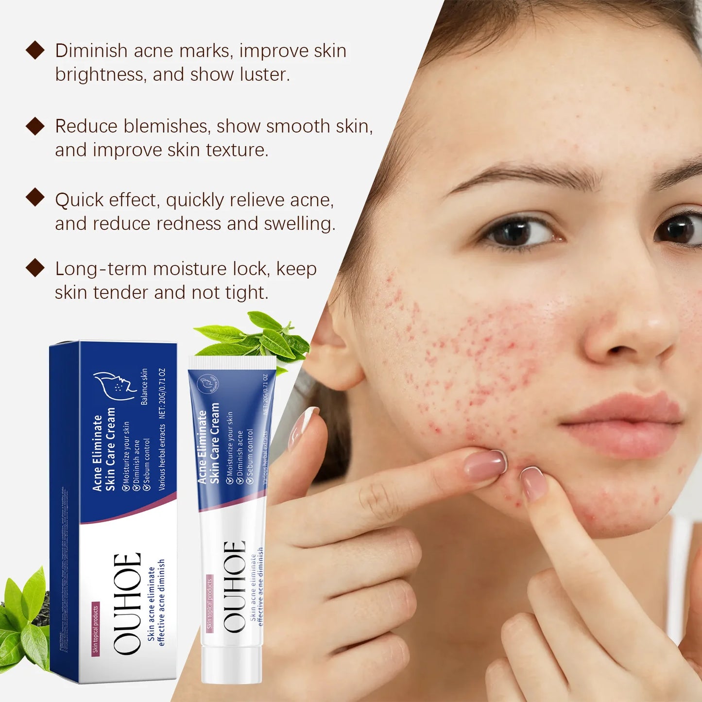 Pimple Acne Treatment Face Cream Oil Control Nourish Balance Refreshing Repairing Pimple Remover Acne Removing Cleansing Cream