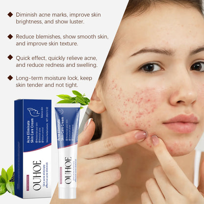 Pimple Acne Treatment Face Cream Oil Control Nourish Balance Refreshing Repairing Pimple Remover Acne Removing Cleansing Cream