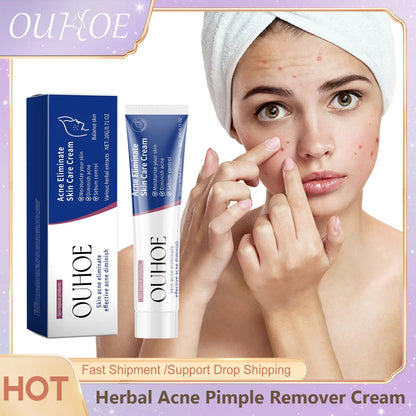 Pimple Acne Treatment Face Cream Oil Control Nourish Balance Refreshing Repairing Pimple Remover Acne Removing Cleansing Cream