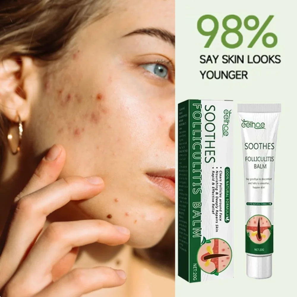 Anti-Acne Cream Effectively Removes Skin Nodules Pustules Cysts Papules Blackheads Men And Women Acne Skin Care Essence Cream