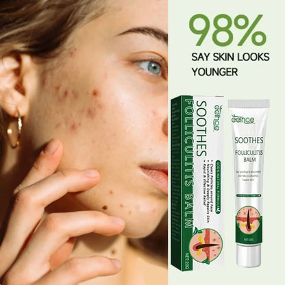 Anti-Acne Cream Effectively Removes Skin Nodules Pustules Cysts Papules Blackheads Men And Women Acne Skin Care Essence Cream