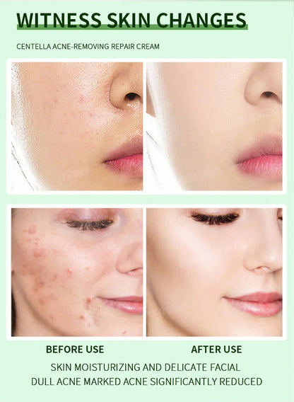 Anti-Acne Cream Effectively Removes Skin Nodules Pustules Cysts Papules Blackheads Men And Women Acne Skin Care Essence Cream