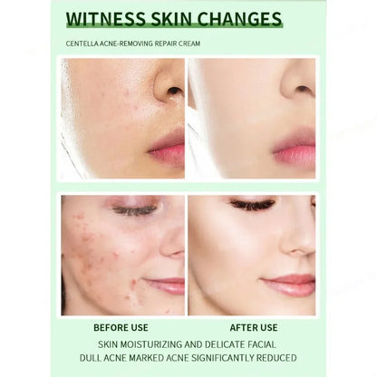 Anti-Acne Cream Effectively Removes Skin Nodules Pustules Cysts Papules Blackheads Men And Women Acne Skin Care Essence Cream