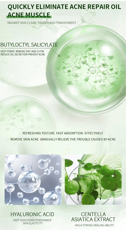 Anti-Acne Cream Effectively Removes Skin Nodules Pustules Cysts Papules Blackheads Men And Women Acne Skin Care Essence Cream