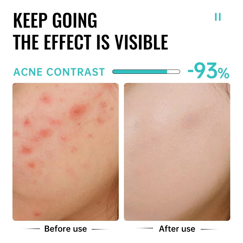 Salicylic Acid Acne Treatment Face Cream Repair Pimple Spots Deep Cleaning Pore Shrinking Anti-acne Scar Oil Control Moisturizer