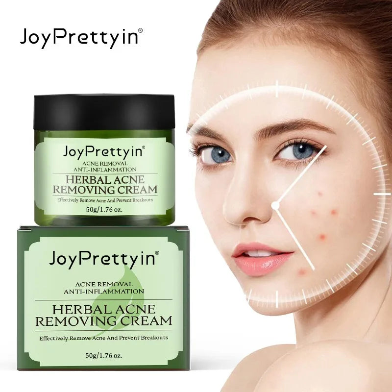 Herbal Acne Moving Cream Long Lasting Moisturizing Face Care Products Oil Control Fading Acne Scars Marks Skin Care Beauty