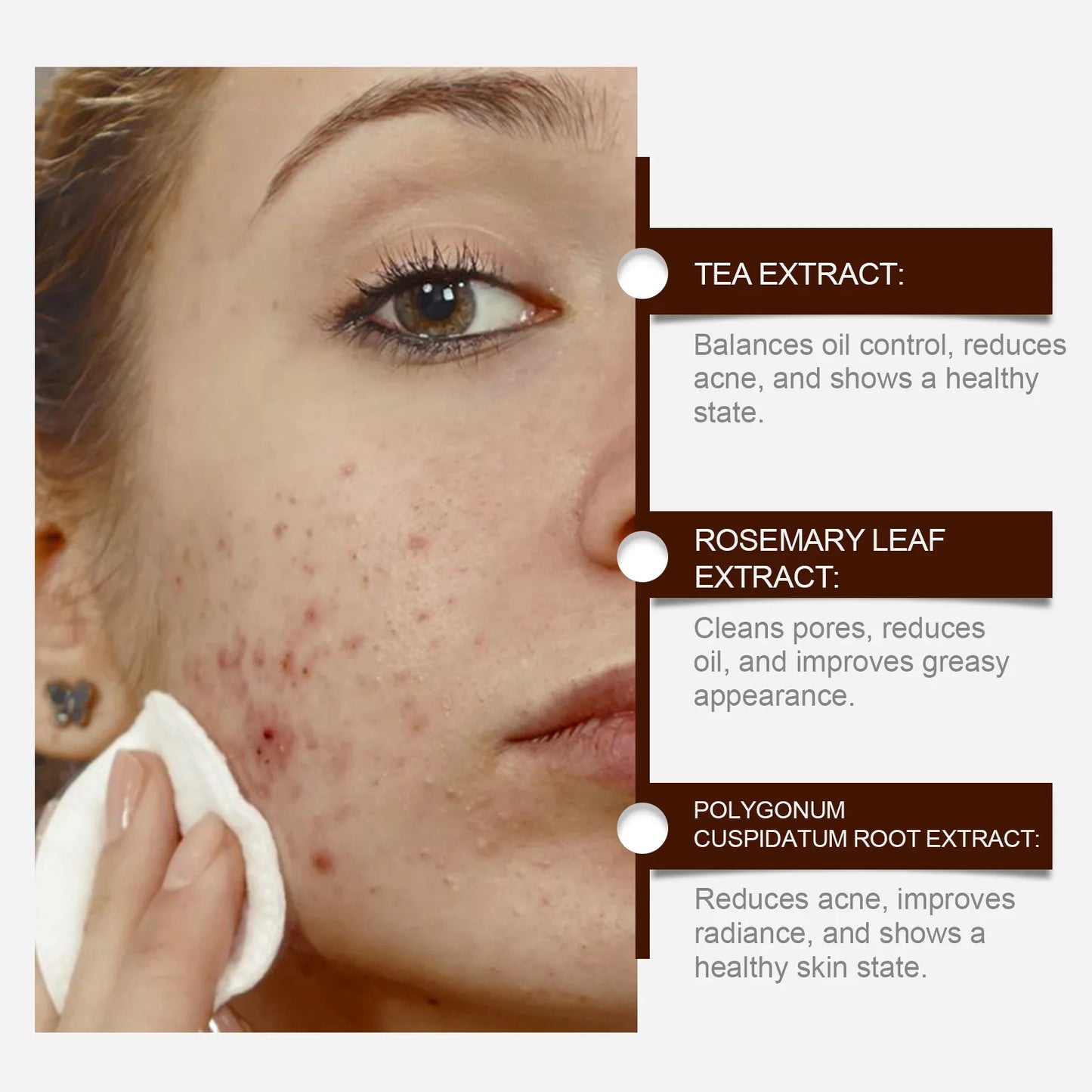 Pimple Acne Treatment Face Cream Oil Control Nourish Balance Refreshing Repairing Pimple Remover Acne Removing Cleansing Cream