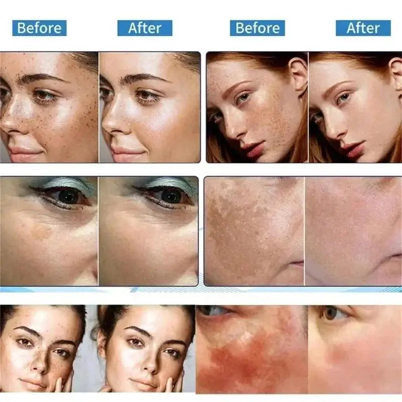 Powerful Spot-Removing Whiten Cream Brighten Skin Fast Eliminates Melanin Pigmentation Melasma Dark Spots Korean Skin Care