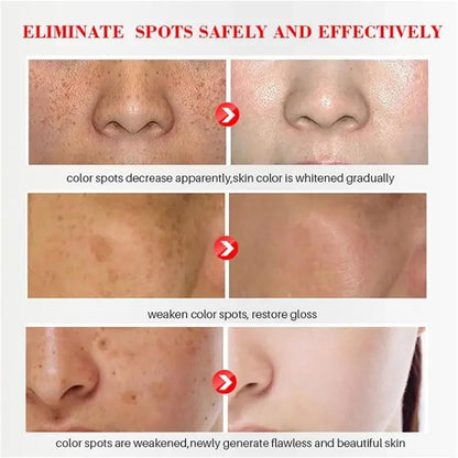 Powerful Spot-Removing Whiten Cream Brighten Skin Fast Eliminates Melanin Pigmentation Melasma Dark Spots Korean Skin Care